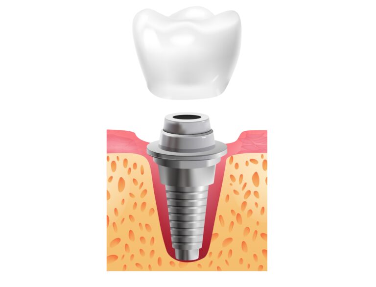 Realistic tooth stages dental implant composition with text and view of prosthetics stage of dental implantation vector illustration