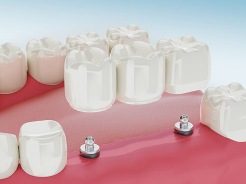 Implantes dentales en Pozuelo